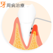 牙周病治療