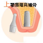 人工植牙~上顎竇增高