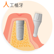 植牙術後注意事項